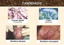 candidiasis-genital