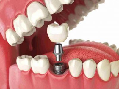 implante-diente
